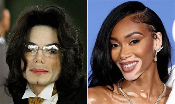 Vitiligo Michael Jackson Skin Condition: Understanding the Life and Legacy